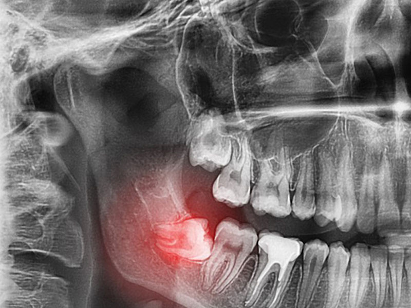Hiện nay tình trạng "Răng khôn mọc nghiêng" rất phổ biến khiến mọi người đau đầu, vậy Triệu Chứng & Cách Xử Lý như nào?