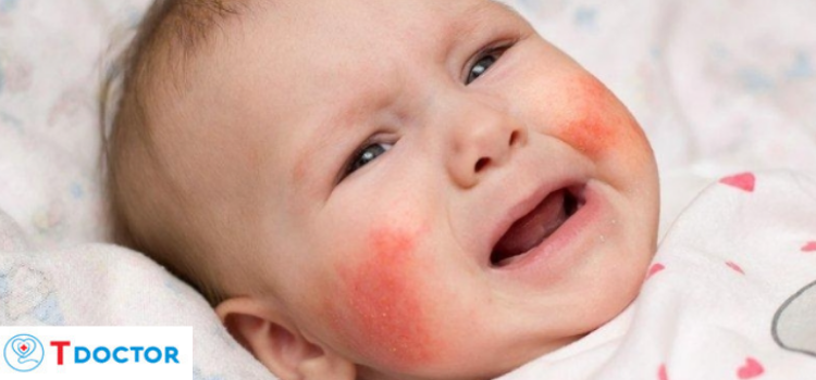 Mọc mụn sữa ở trẻ sơ sinh bao lâu hết? Lời khuyên từ bác sĩ