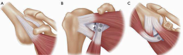  KỸ THUẬT CỐ ĐỊNH GÂN CƠ DƯỚI VAI VÀO BỜ TRƯỚC Ổ CHẢO QUA NỘI SOI