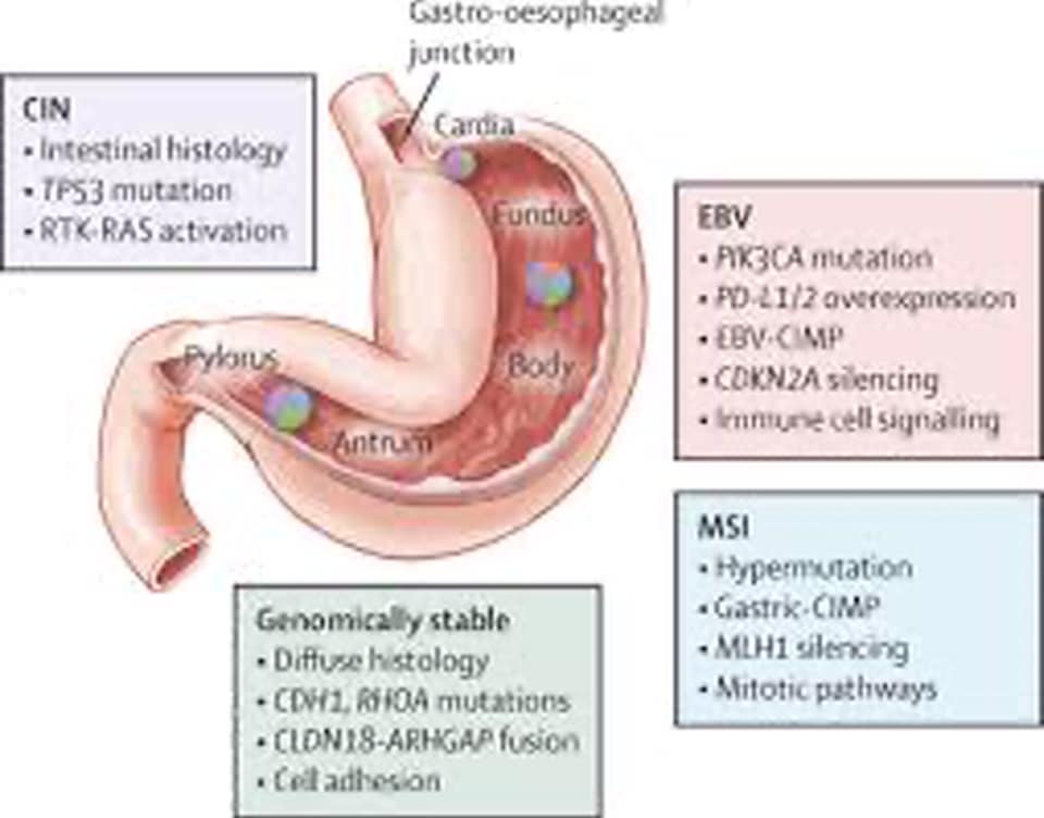 SINH HỌC PHÂN TỬ TRONG UNG THƯ DẠ DẦY
