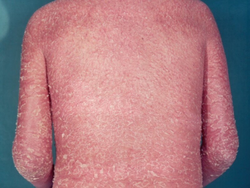   Bệnh vảy nến toàn thân nên kiêng ăn gì để nhanh khỏi?