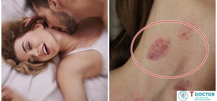 Hickey là gì? Những lưu ý để hickey một cách an toàn