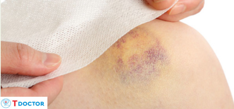 Vỡ mạch máu dưới da là gì? Chuyên gia giải đáp