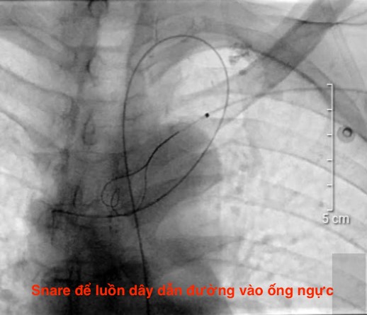ĐÃ TÌM RA MỘT NGUYÊN NHÂN GÂY “ĐAU BỤNG KHÔNG RÕ NGUYÊN NHÂN”.