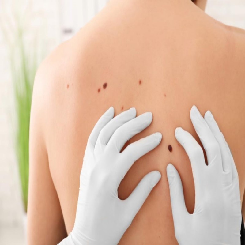 Chẩn đoán ung thư da