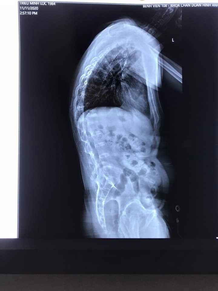 PHẪU THUẬT ĐIỀU TRỊ ĐAU Ở NGƯỜI BỆNH VIÊM CỘT SỐNG DÍNH KHỚP